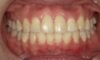 【症例　矯正治療】上顎前歯前突、下顎前歯叢生、下顎右偏位