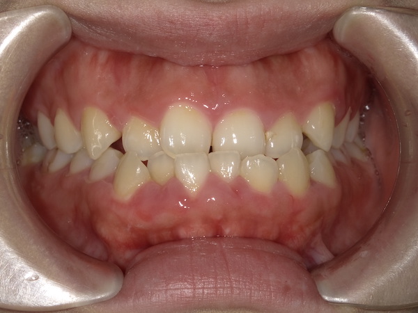 【症例　矯正治療】下顎前突、前歯逆被蓋叢生、非抜歯