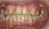 【症例　矯正治療】上下前歯叢生、下顎右偏位　治療法　GEAW、３Dリンガルアーチ、非抜歯