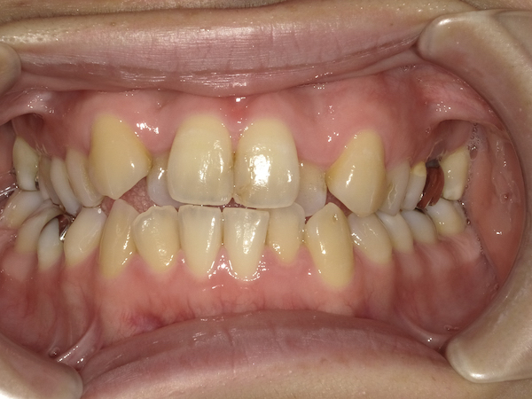 【症例　矯正治療】上下前歯叢生、下顎右偏位　治療法　GEAW、３Dリンガルアーチ、非抜歯