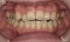 【症例　矯正治療】前歯開咬症例、臼歯部咬合痛、３Dリンガルアーチ、GEAW、非抜歯