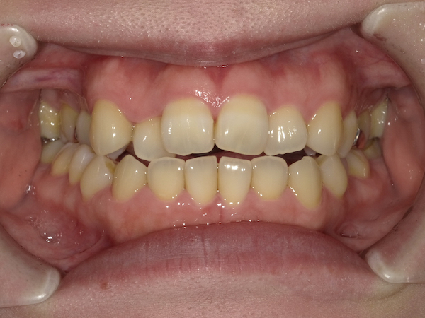 【症例　矯正治療】前歯開咬症例、臼歯部咬合痛、３Dリンガルアーチ、GEAW、非抜歯