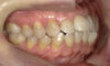 【症例　矯正治療】上顎前歯前突、下顎左偏位